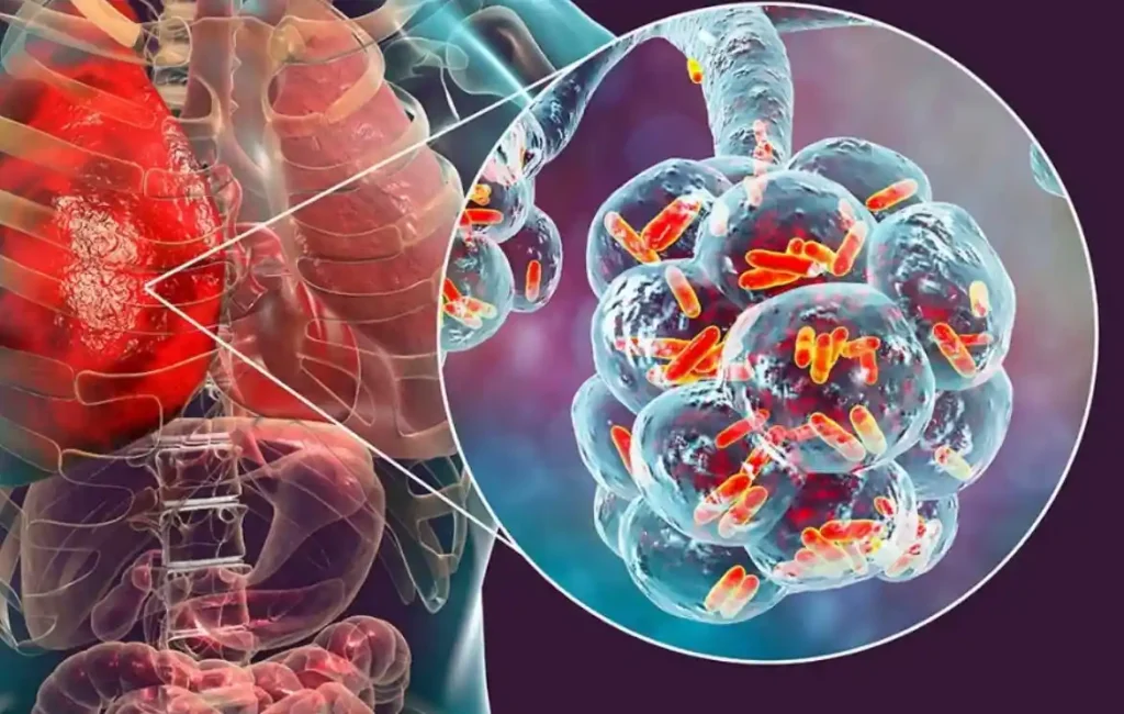 Klordioksit Lejyonella